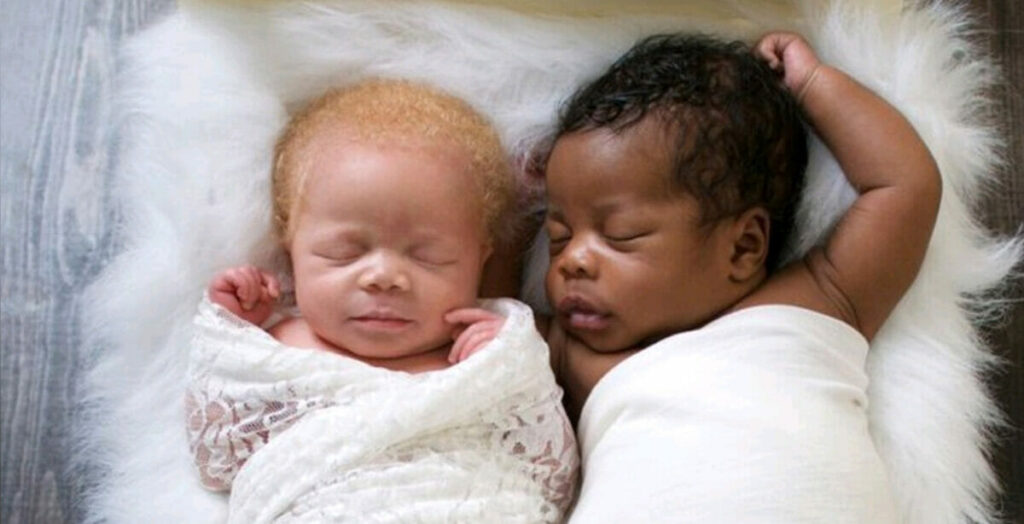 Photographer gives birth to twins— then takes amazing photos of her albino daughter