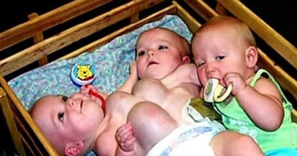 A pair of conjoined rare triplets were abandoned for adoption 20 years ago— Here are the triplets today