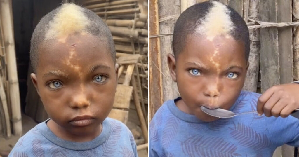 Young boy with white hairs, natural blue eyes, and lightning mark down his face goes viral