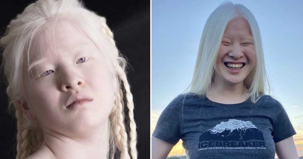 Girl who was abandoned by parents for her looks wants to prove the world wrong—now she models for Vogue