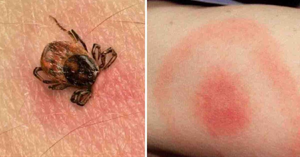 Mother discovers insect bite after son becomes paralyzed
