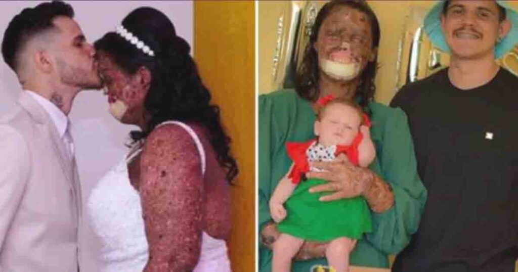 Woman with unusual skin problem beats bad comments and finds true love