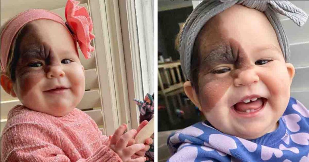Dedicated mom determined to prove to daughter with rare birthmark that she is beautiful
