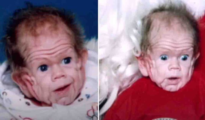 Meet Tomm Tennent—the baby born with the skin of a five-year-old