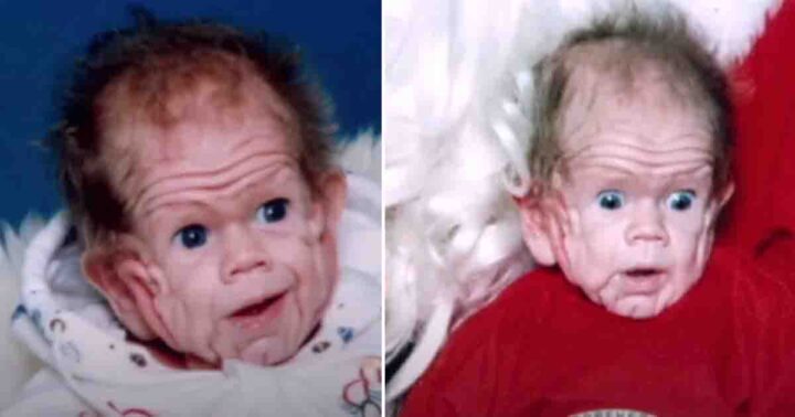 Meet Tomm Tennent—the baby born with the skin of a five-year-old
