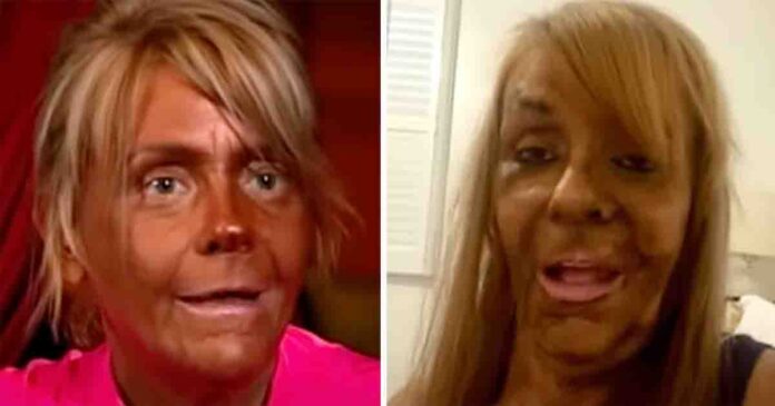 Patricia Krentcil who tanned five days a week and nearly lost her life is now known as 