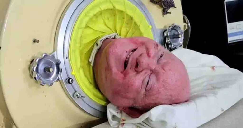 Man who spent over 70 years living in an iron lung has passed away at the age of 78
