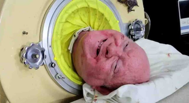 Man who spent over 70 years living in an iron lung has passed away at the age of 78
