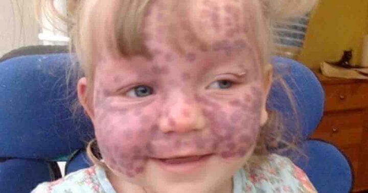 The story of Matilda Callaghan, the little girl covered in polka dots