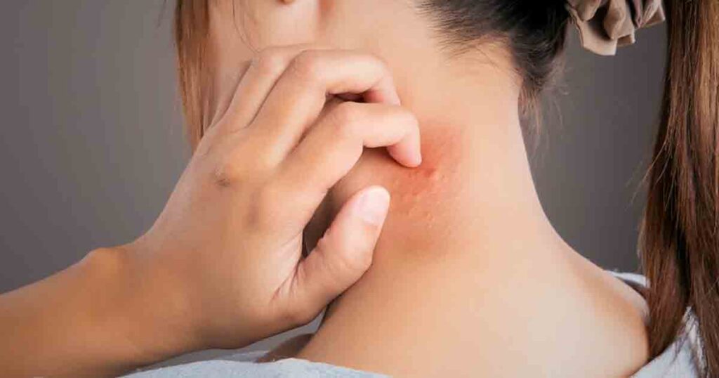 Quick tricks to stop mosquito bites from itching right away