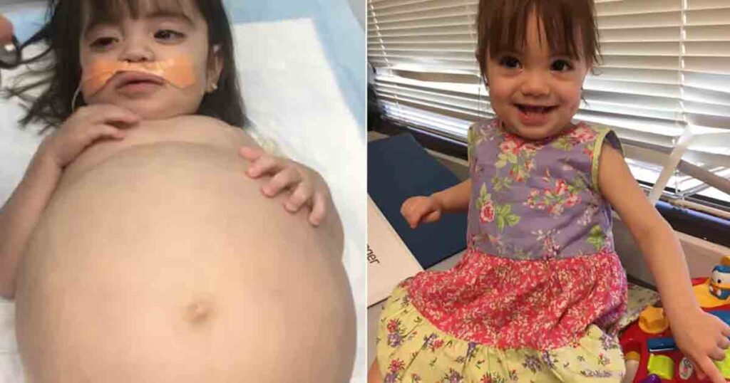 Young girl saved by dad's kidney donation after deadly disease made her look 8 months pregnant