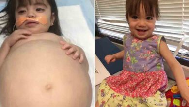 Young girl saved by dad's kidney donation after deadly disease made her look 8 months pregnant