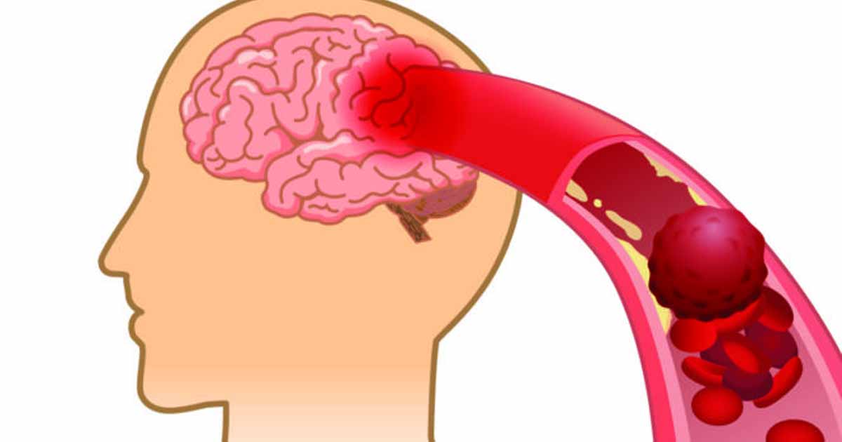 10 warning signs of clogged arteries you should never ignore