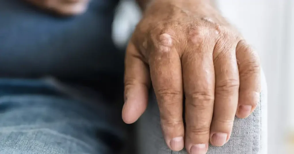 Warning signs on your skin you shouldn’t ignore—Understanding psoriasis and its many faces