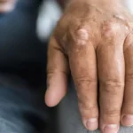 Warning signs on your skin you shouldn’t ignore—Understanding psoriasis and its many faces