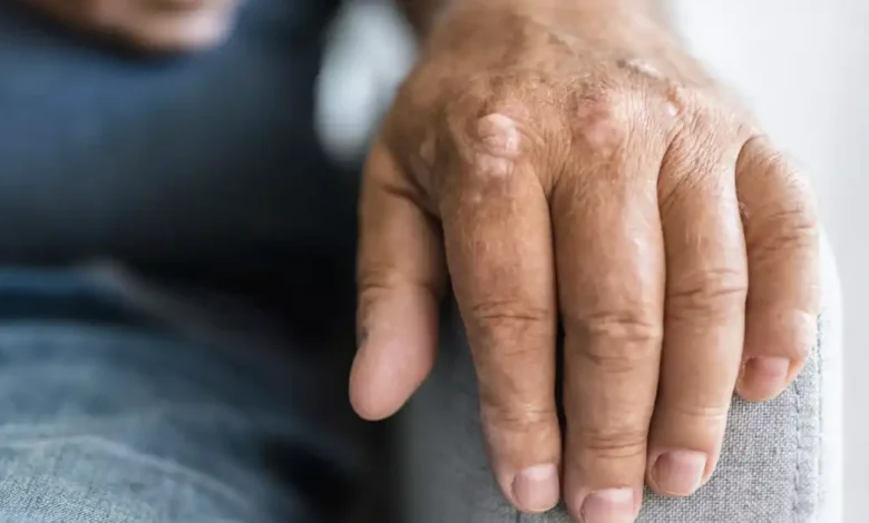 Warning signs on your skin you shouldn’t ignore—Understanding psoriasis and its many faces
