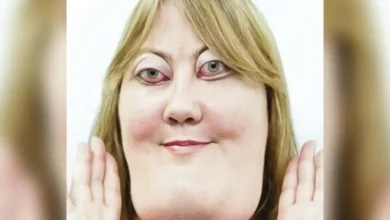 Victoria Wright’s journey with cherubism: how she turned bullying into advocacy