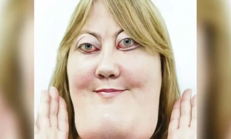 Victoria Wright’s journey with cherubism: how she turned bullying into advocacy
