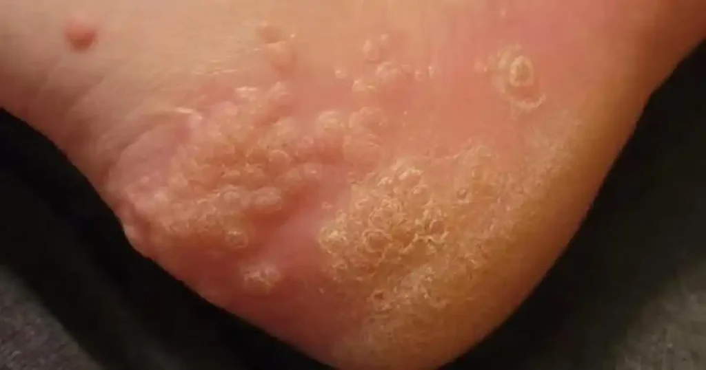 Why wearing used shoes can damage your feet: Here’s what you need to know